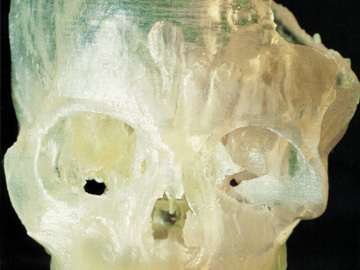Picture depicting the upper half of a human skull with the left cranium broken.