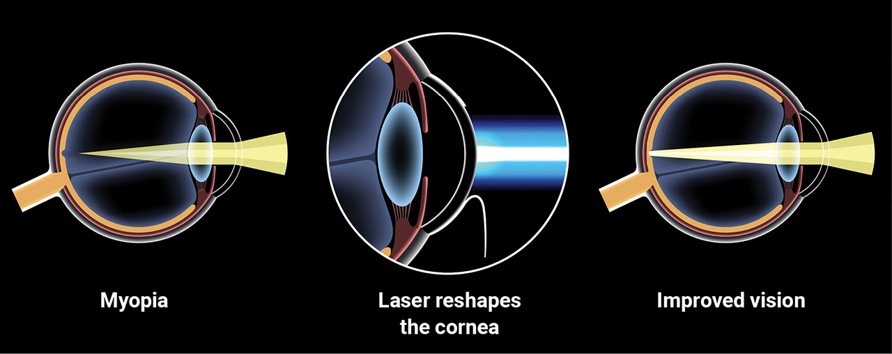 How excimer lasers reshape the cornea to improve vision