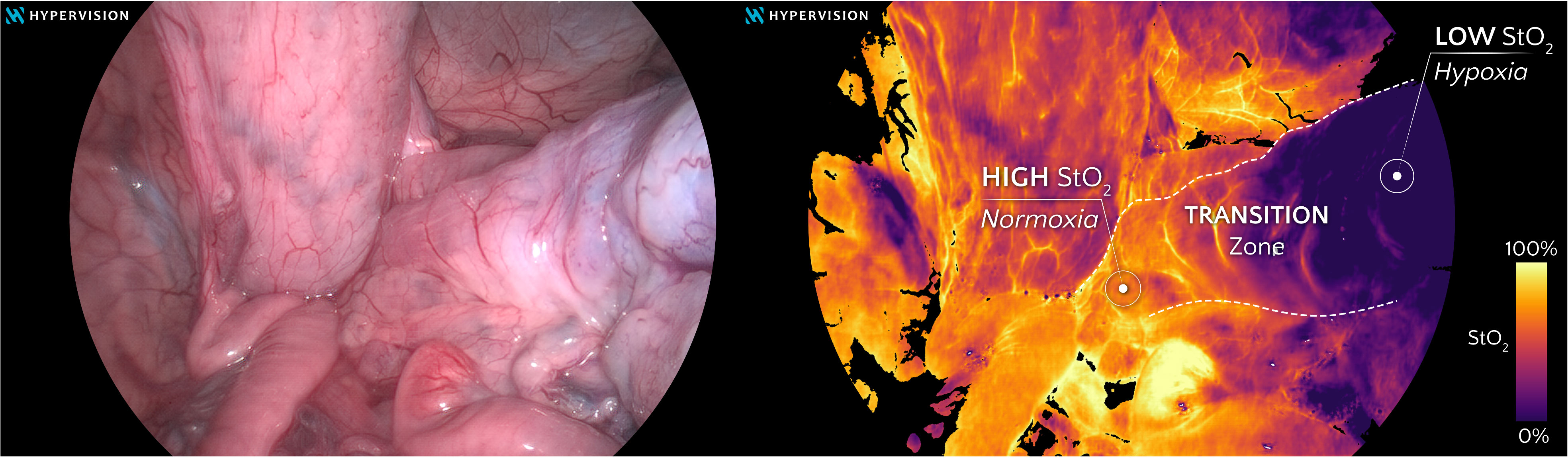 View of surgery with side-by-side of the tissue and the perfusion heatmap