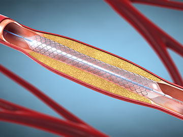 Monitoring Stents Through Skin