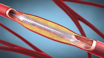Render of artery with stent placed in it