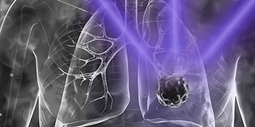 Artist's rendition of cancer in a lung